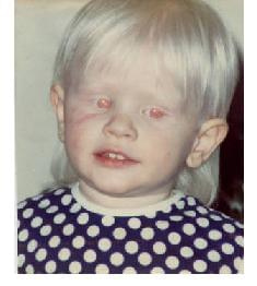 albinotyczne dziecko #dzieci